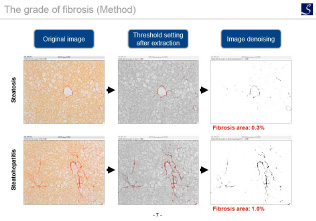 The grade of fibrosis (Method)